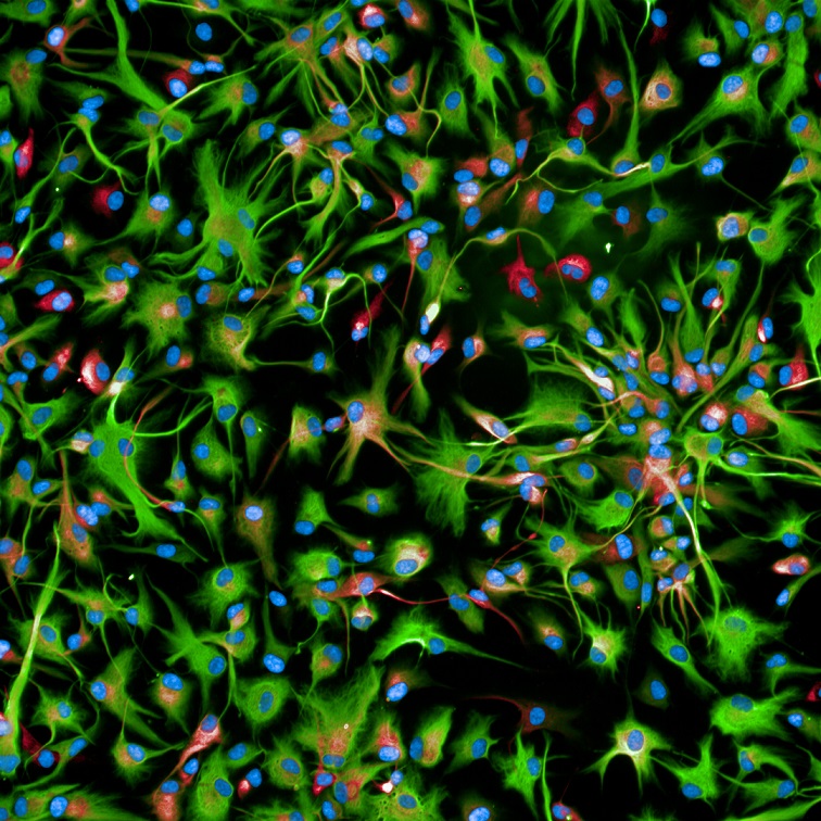 Terapia sperimentale per i bambini affetti da un tumore cerebrale