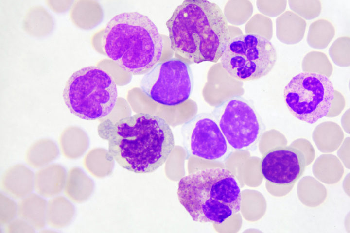 Quando la leucemia era un male incurabile
