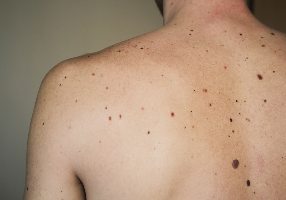 Recenti studi dell’IRCCS per la lotta al melanoma metastatico