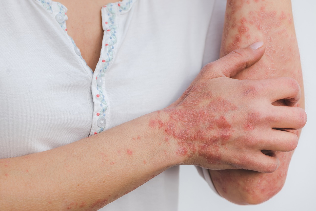 La psoriasi merita di essere inserita nel piano nazionale delle cronicità